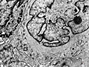 F, 49y. | myelosarcoma … histiocyte-like cells in dermal infiltrates